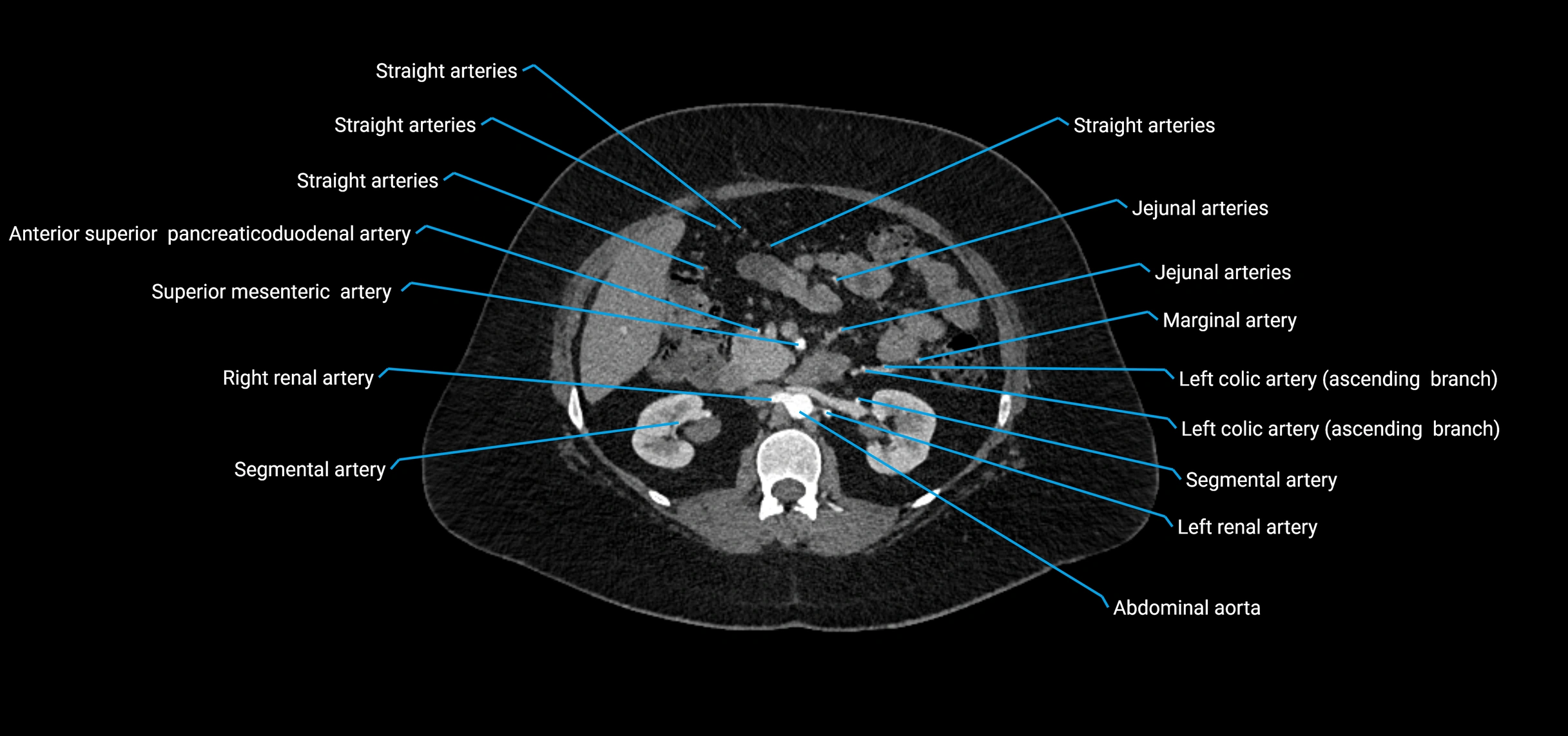 CTA abdomen axial cross sectional anatomy labelled image_74 (2).webp